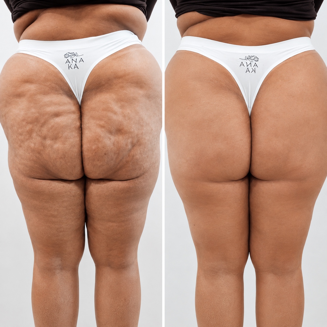 Comparação antes e depois de um caso de AKIncision para textura da pele