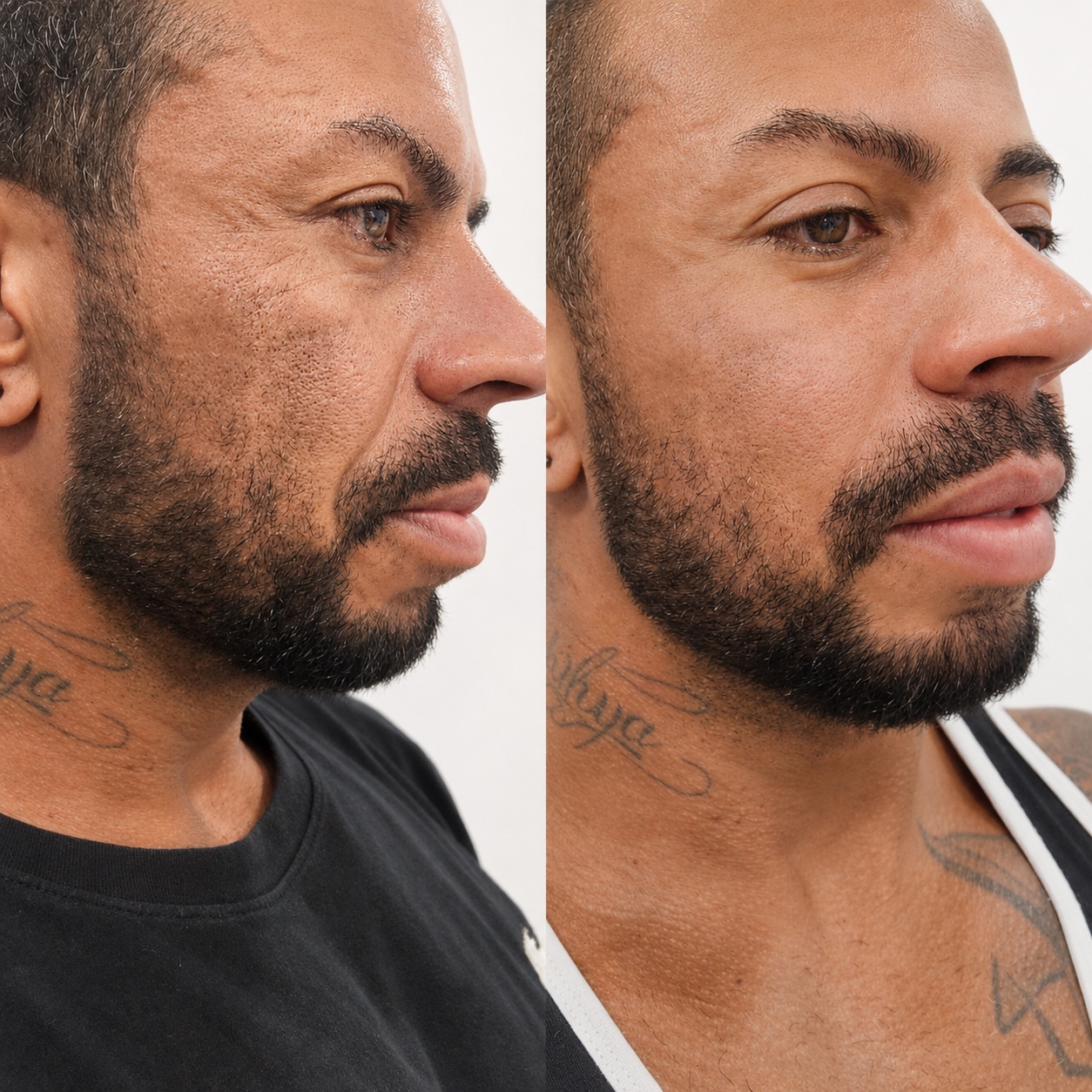 Antes e depois de bioestimulador de colágeno