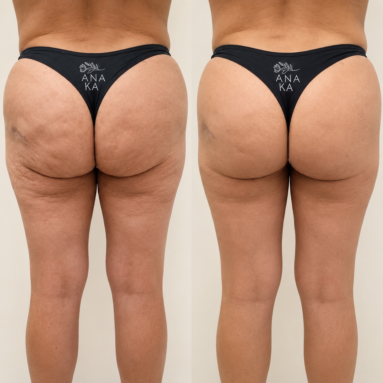 Comparação antes e depois de um caso de preenchimento de glúteo