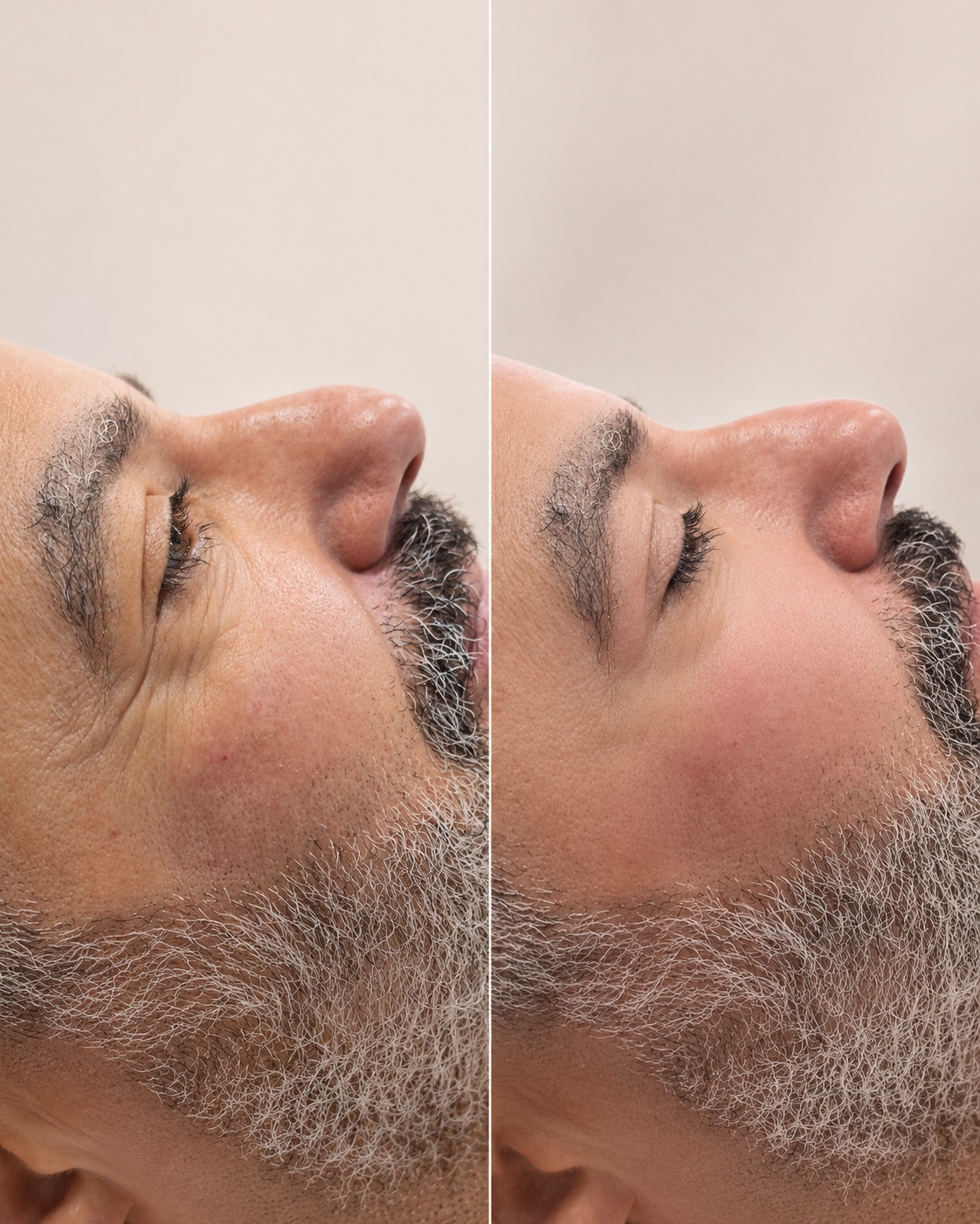 Antes e depois de harmonização facial